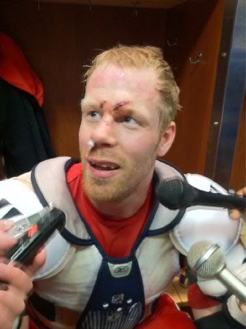 Johan Franzen stitches